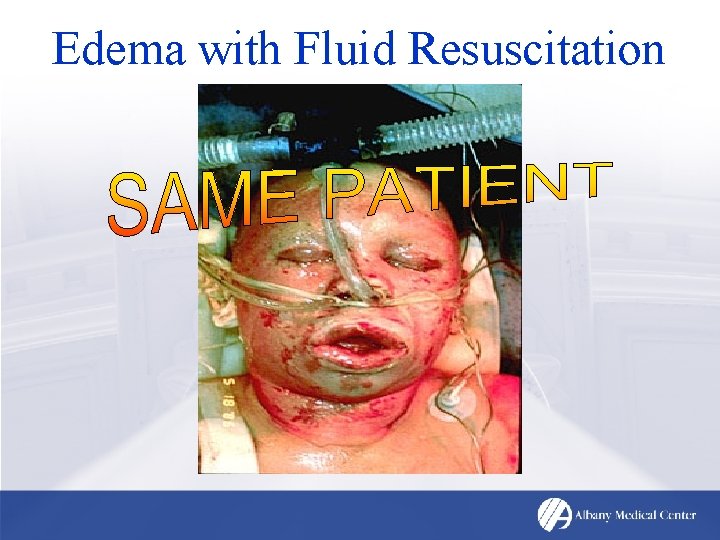 Edema with Fluid Resuscitation 