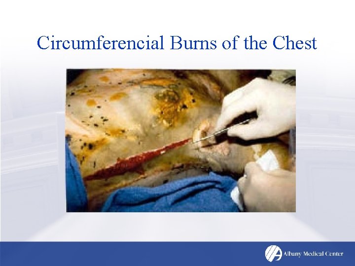 Circumferencial Burns of the Chest 