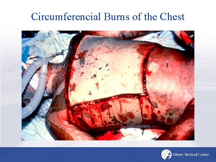 Circumferencial Burns of the Chest 