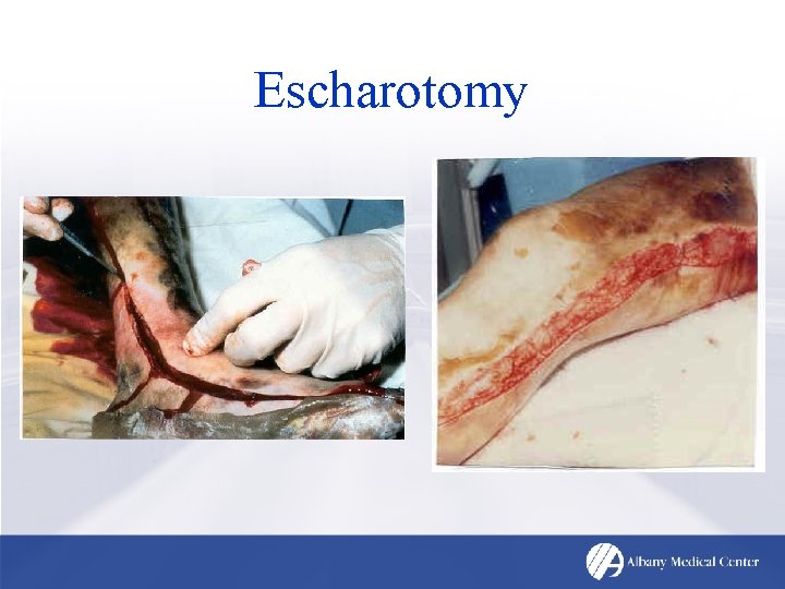 Escharotomy 