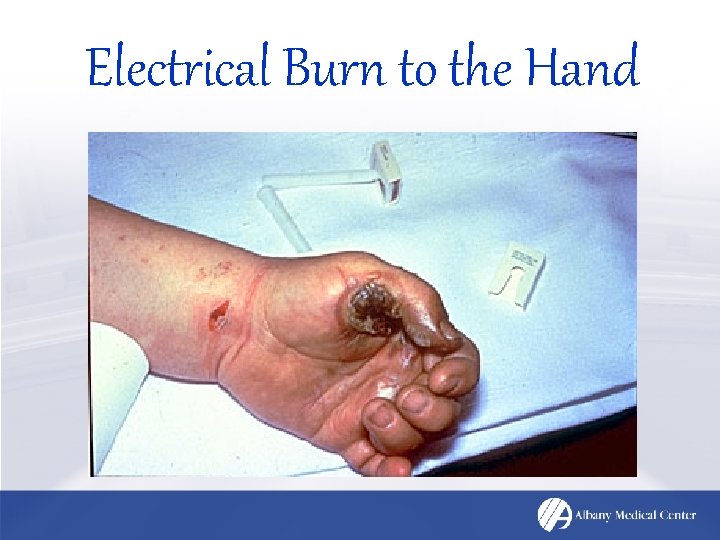 Electrical Burn to the Hand 