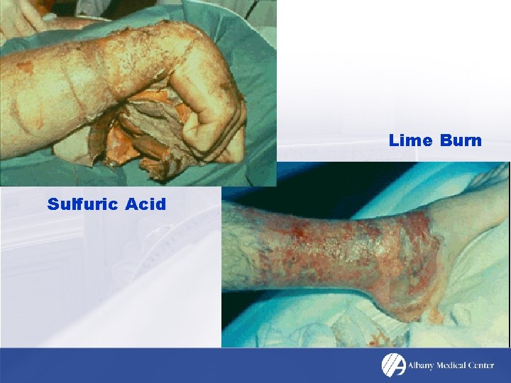 Lime Burn Sulfuric Acid 