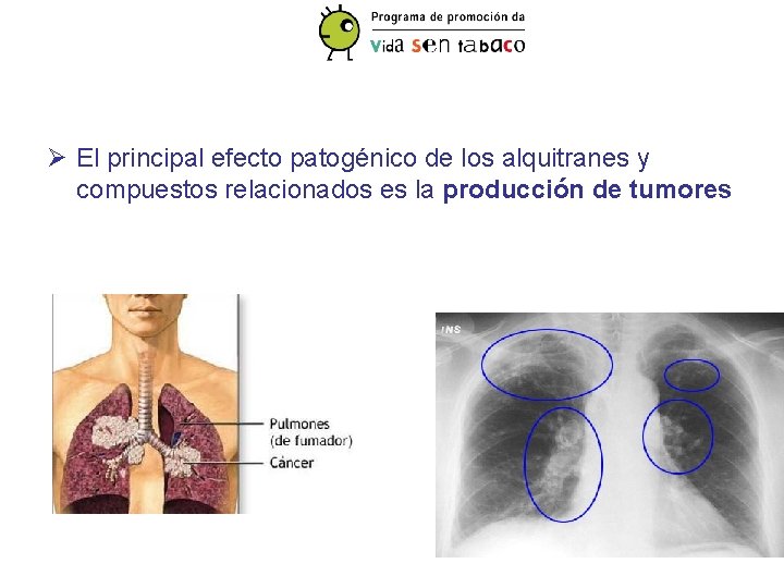 Ø El principal efecto patogénico de los alquitranes y compuestos relacionados es la producción