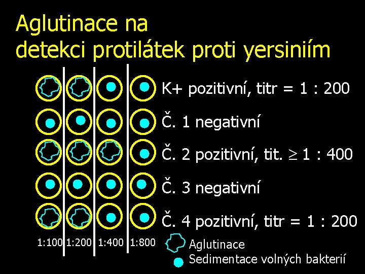 Aglutinace na detekci protilátek proti yersiniím K+ pozitivní, titr = 1 : 200 Č.