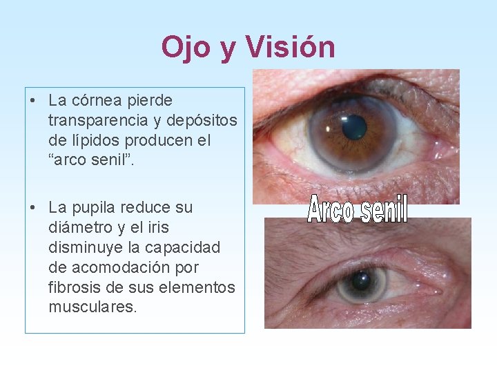 Ojo y Visión • La córnea pierde transparencia y depósitos de lípidos producen el