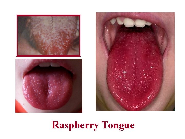 Raspberry Tongue 