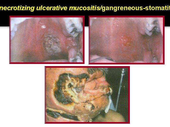 necrotizing ulcerative mucositis/gangreneous-stomatit mucositis/ 