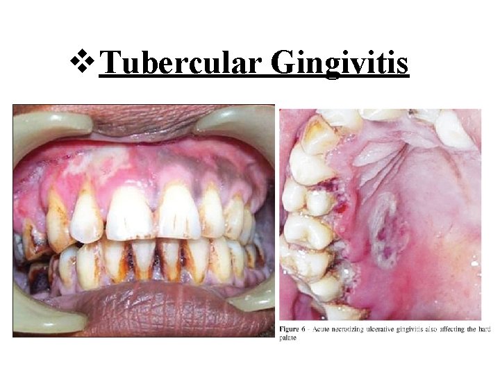 v Tubercular Gingivitis 