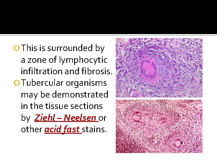  This is surrounded by a zone of lymphocytic infiltration and fibrosis. Tubercular organisms