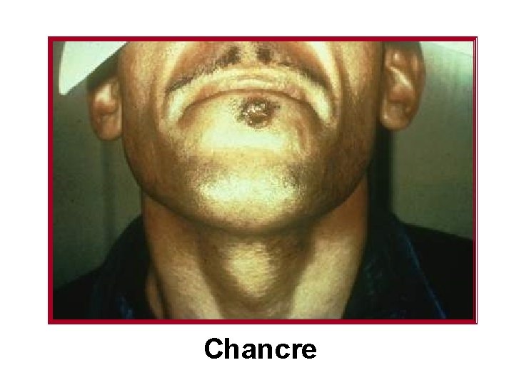 Chancre 