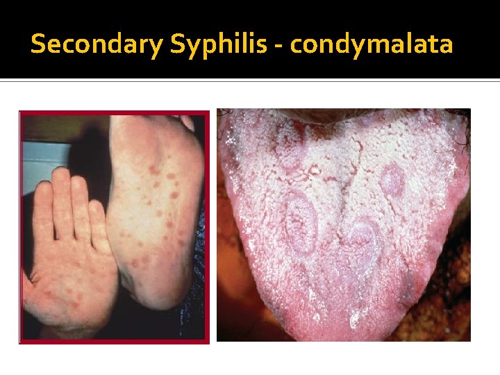 Secondary Syphilis - condymalata 