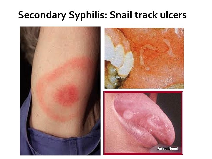 Secondary Syphilis: Snail track ulcers 