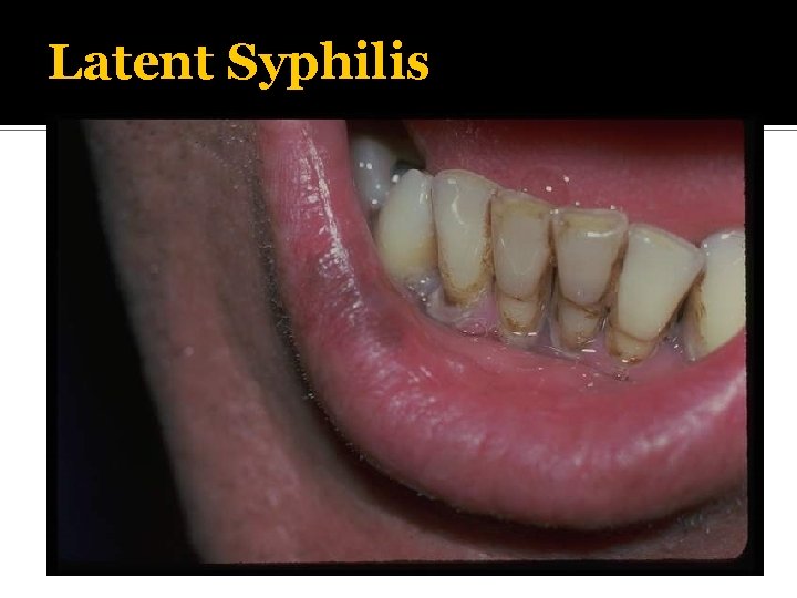 Latent Syphilis 