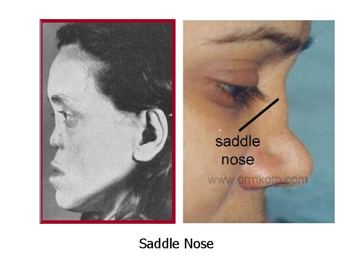 Saddle Nose 