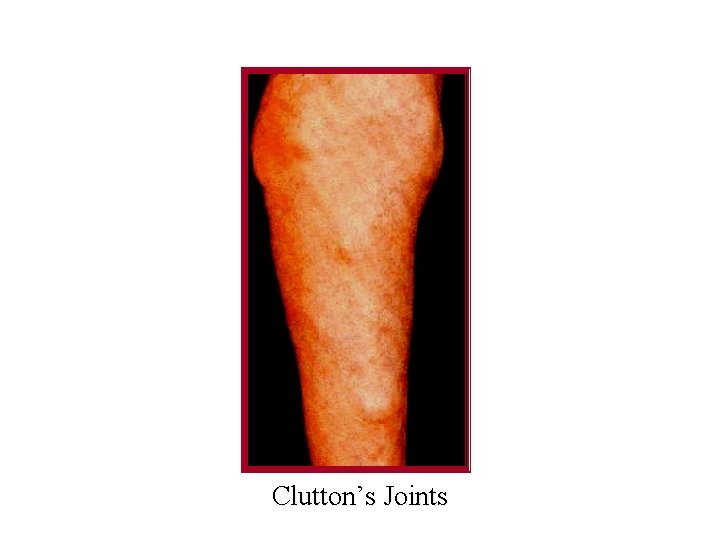 Clutton’s Joints 