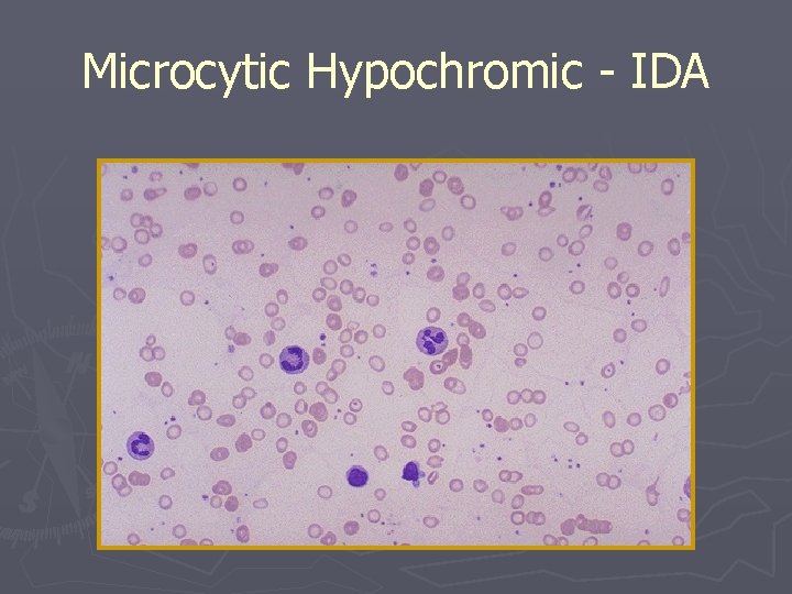 Microcytic Hypochromic - IDA 