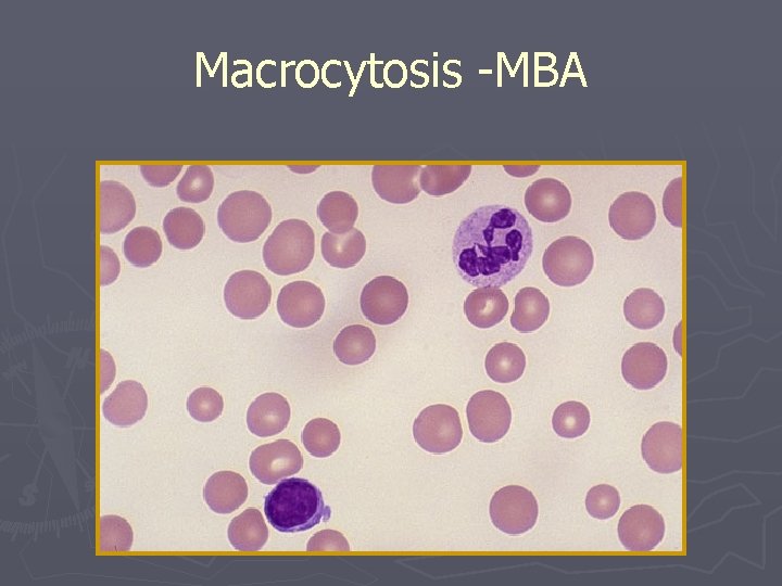 Macrocytosis -MBA 
