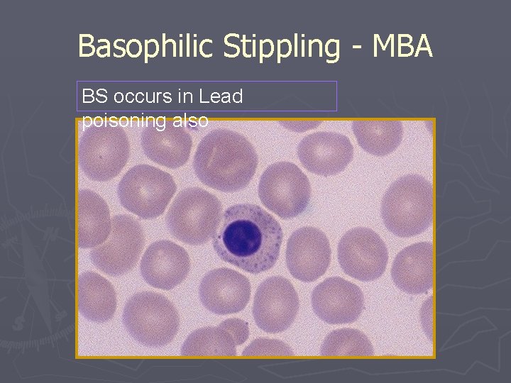 Basophilic Stippling - MBA BS occurs in Lead poisoning also 