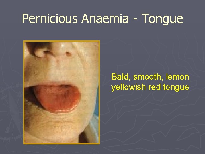 Pernicious Anaemia - Tongue Bald, smooth, lemon yellowish red tongue 