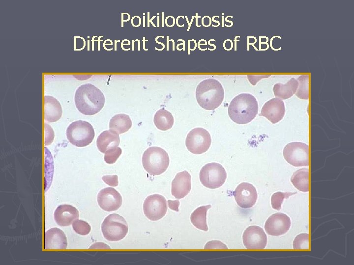 Poikilocytosis Different Shapes of RBC 