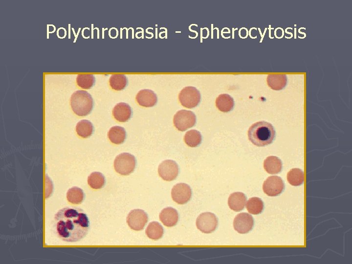 Polychromasia - Spherocytosis 
