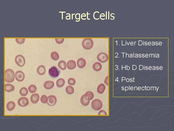 Target Cells 1. Liver Disease 2. Thalassemia 3. Hb D Disease 4. Post splenectomy