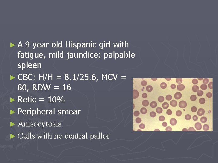 ► A 9 year old Hispanic girl with fatigue, mild jaundice; palpable spleen ►