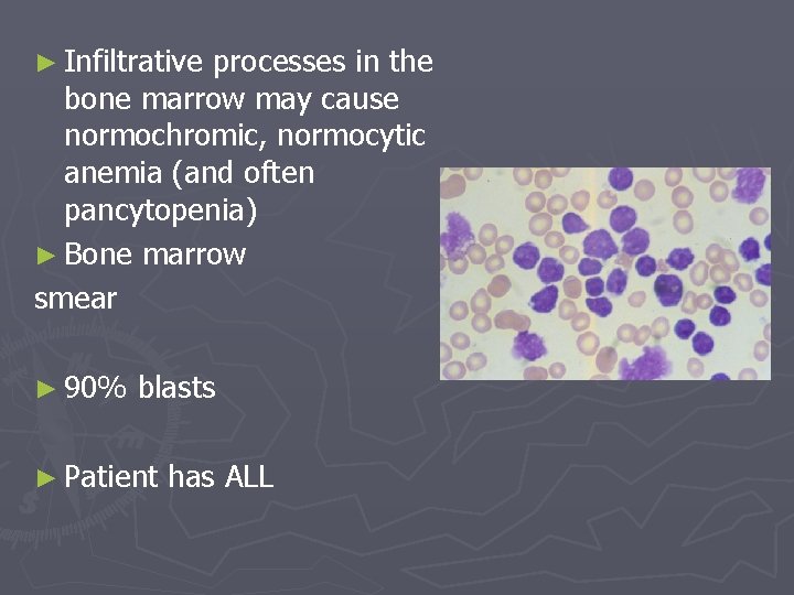 ► Infiltrative processes in the bone marrow may cause normochromic, normocytic anemia (and often
