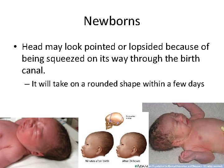 Newborns • Head may look pointed or lopsided because of being squeezed on its