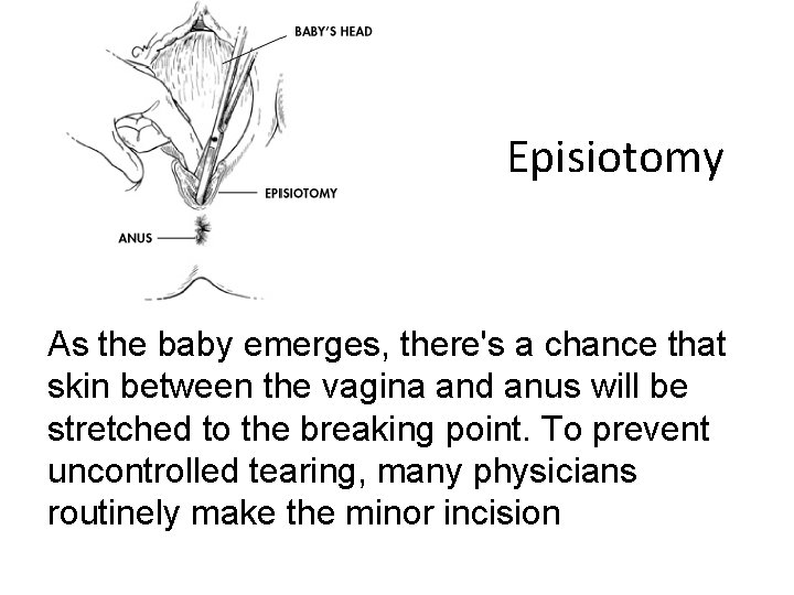 Episiotomy As the baby emerges, there's a chance that skin between the vagina and