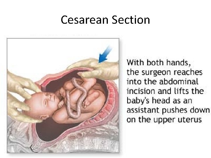 Cesarean Section 