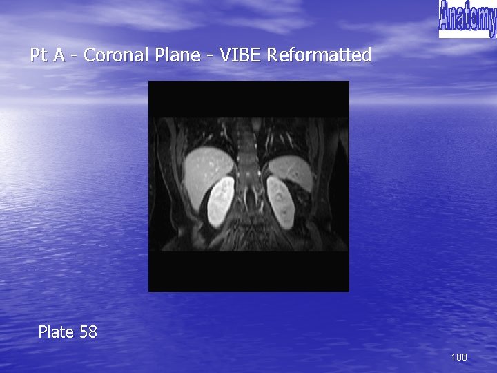 Pt A - Coronal Plane - VIBE Reformatted Plate 58 100 