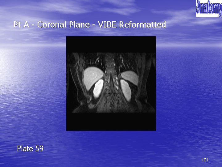 Pt A - Coronal Plane - VIBE Reformatted Plate 59 101 