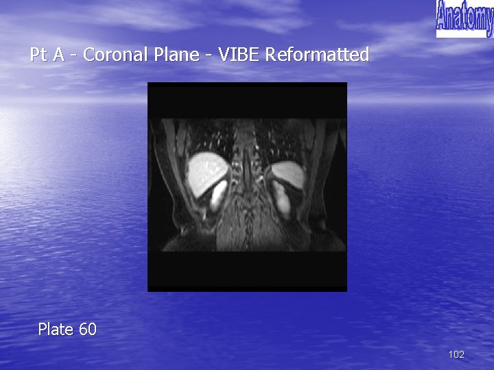 Pt A - Coronal Plane - VIBE Reformatted Plate 60 102 