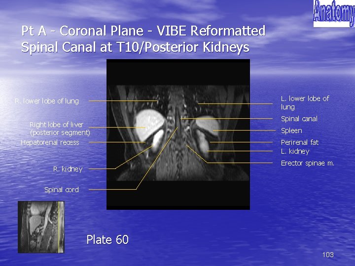 Pt A - Coronal Plane - VIBE Reformatted Spinal Canal at T 10/Posterior Kidneys
