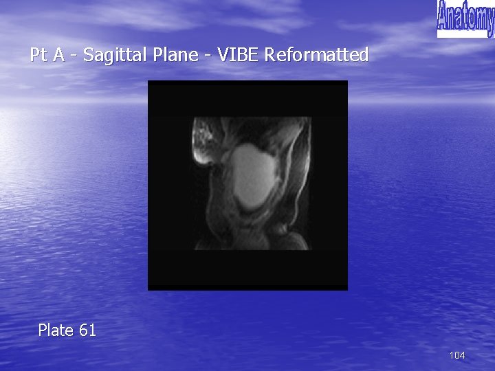 Pt A - Sagittal Plane - VIBE Reformatted Plate 61 104 