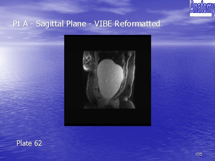 Pt A - Sagittal Plane - VIBE Reformatted Plate 62 105 