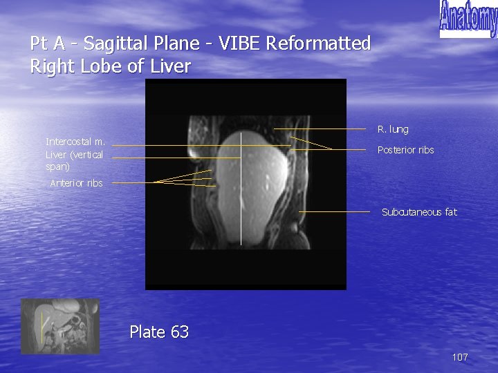 Pt A - Sagittal Plane - VIBE Reformatted Right Lobe of Liver R. lung