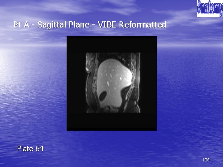 Pt A - Sagittal Plane - VIBE Reformatted Plate 64 108 