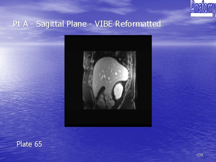 Pt A - Sagittal Plane - VIBE Reformatted Plate 65 109 