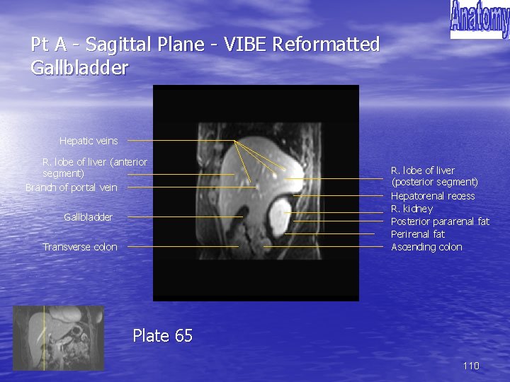 Pt A - Sagittal Plane - VIBE Reformatted Gallbladder Hepatic veins R. lobe of