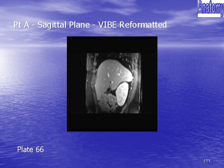 Pt A - Sagittal Plane - VIBE Reformatted Plate 66 111 