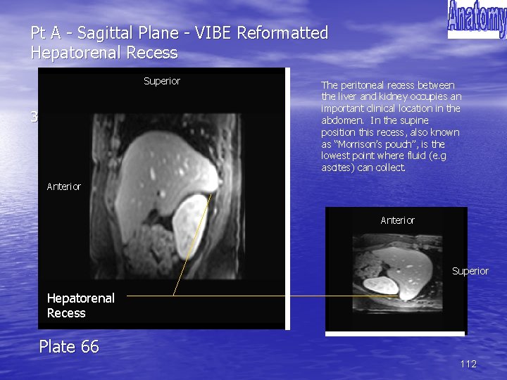 Pt A - Sagittal Plane - VIBE Reformatted Hepatorenal Recess Superior 30 The peritoneal