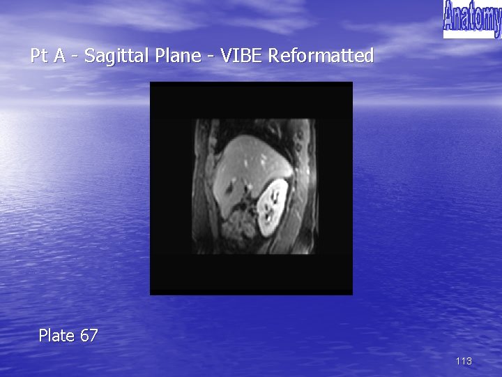 Pt A - Sagittal Plane - VIBE Reformatted Plate 67 113 