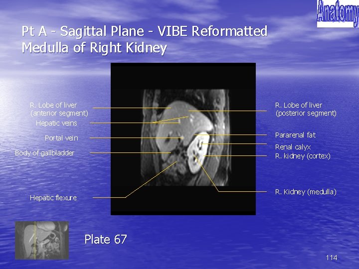 Pt A - Sagittal Plane - VIBE Reformatted Medulla of Right Kidney R. Lobe