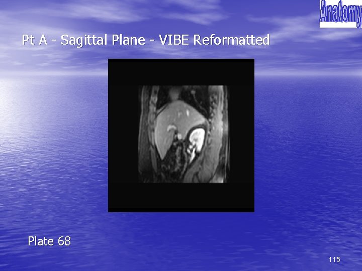Pt A - Sagittal Plane - VIBE Reformatted Plate 68 115 