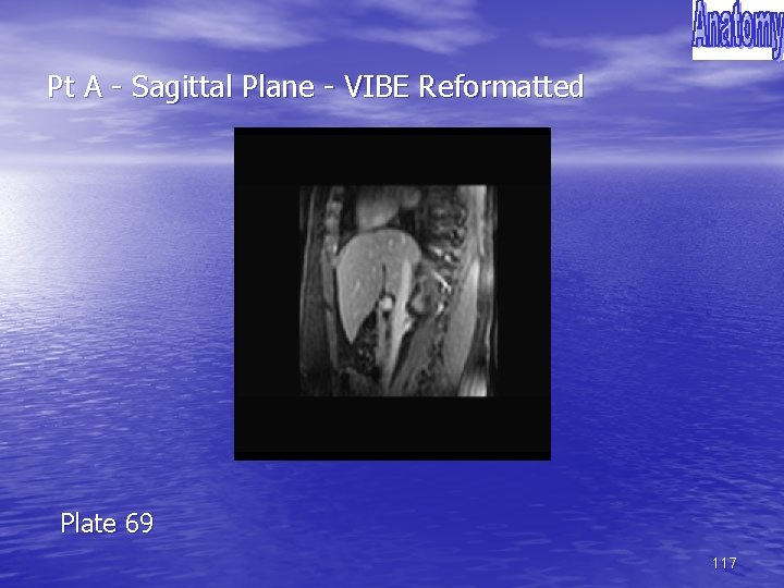Pt A - Sagittal Plane - VIBE Reformatted Plate 69 117 