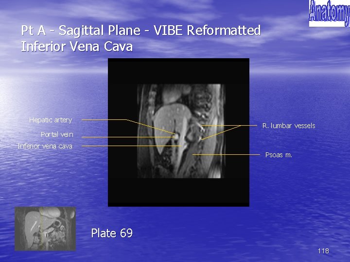 Pt A - Sagittal Plane - VIBE Reformatted Inferior Vena Cava Hepatic artery R.