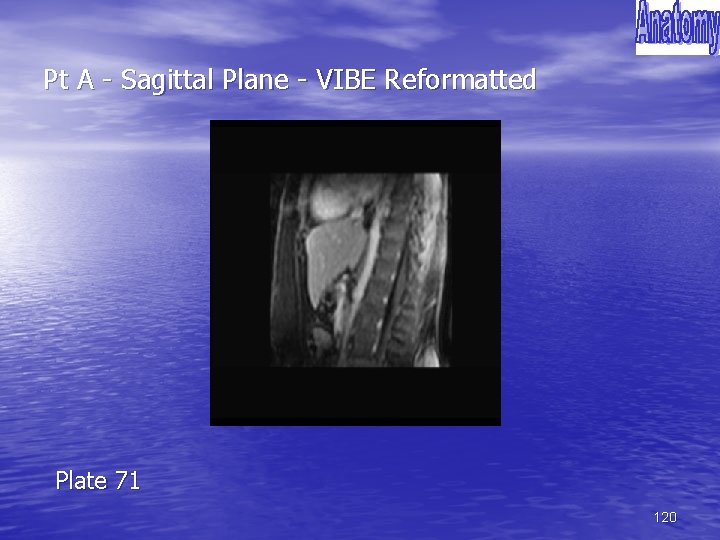 Pt A - Sagittal Plane - VIBE Reformatted Plate 71 120 