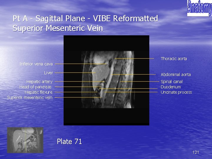 Pt A - Sagittal Plane - VIBE Reformatted Superior Mesenteric Vein Thoracic aorta Inferior